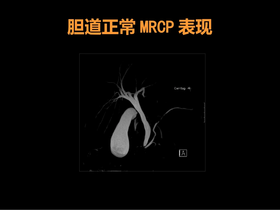 MRCP对胆道疾病的诊断_第8页