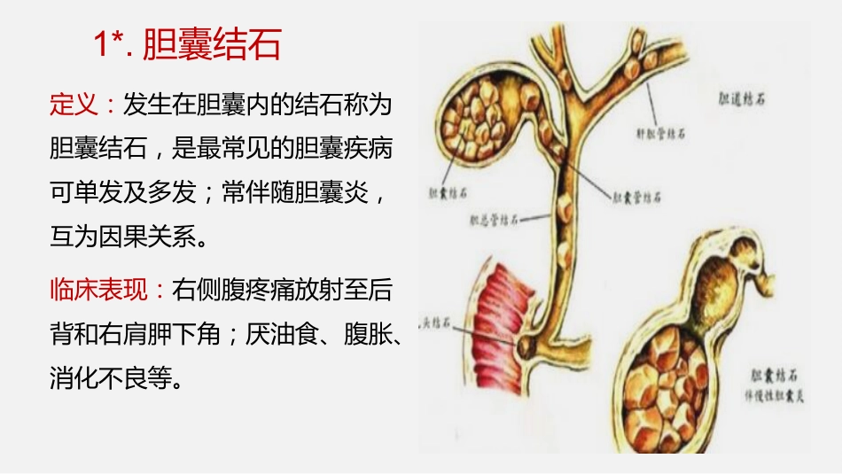 胆囊结石及胆囊炎超声诊断_第10页