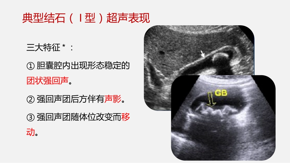 胆囊结石及胆囊炎超声诊断_第11页