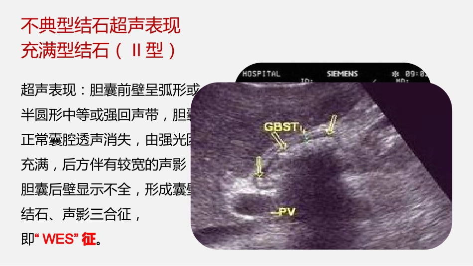 胆囊结石及胆囊炎超声诊断_第12页