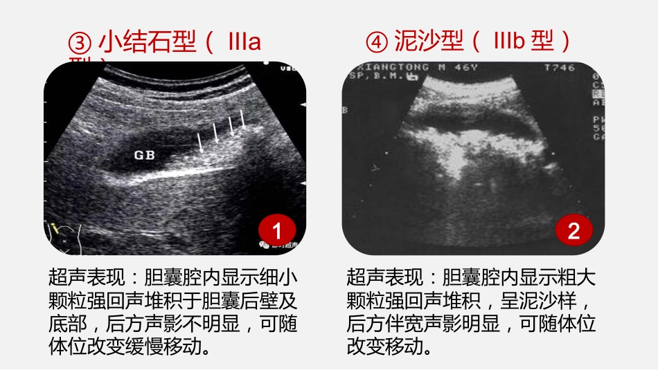 胆囊结石及胆囊炎超声诊断_第13页