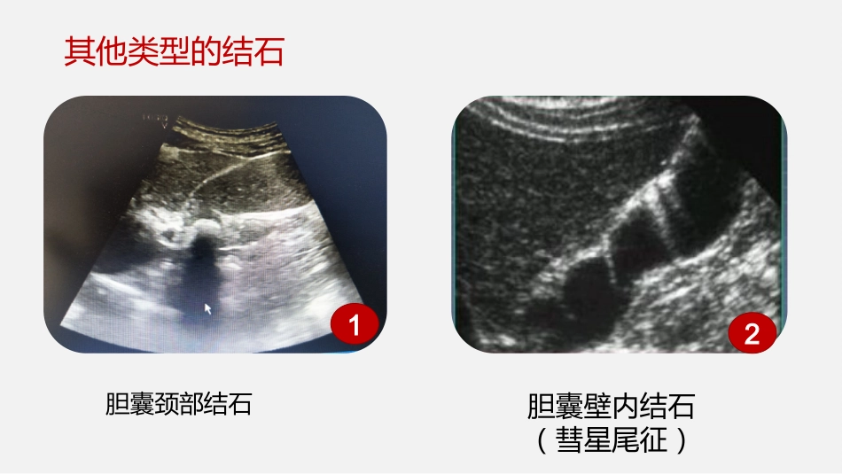 胆囊结石及胆囊炎超声诊断_第14页