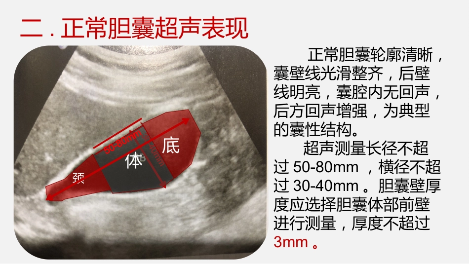胆囊结石及胆囊炎超声诊断_第5页