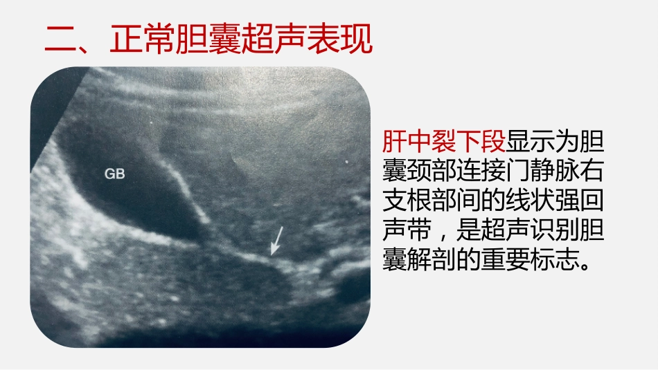 胆囊结石及胆囊炎超声诊断_第6页