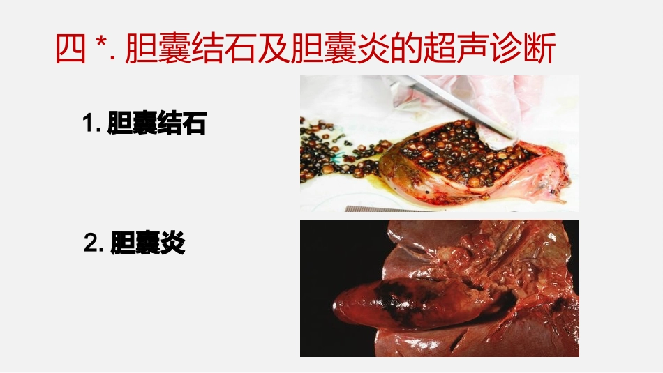 胆囊结石及胆囊炎超声诊断_第9页