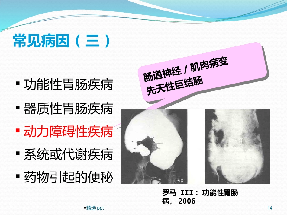 《慢性便秘的诊治》_第14页
