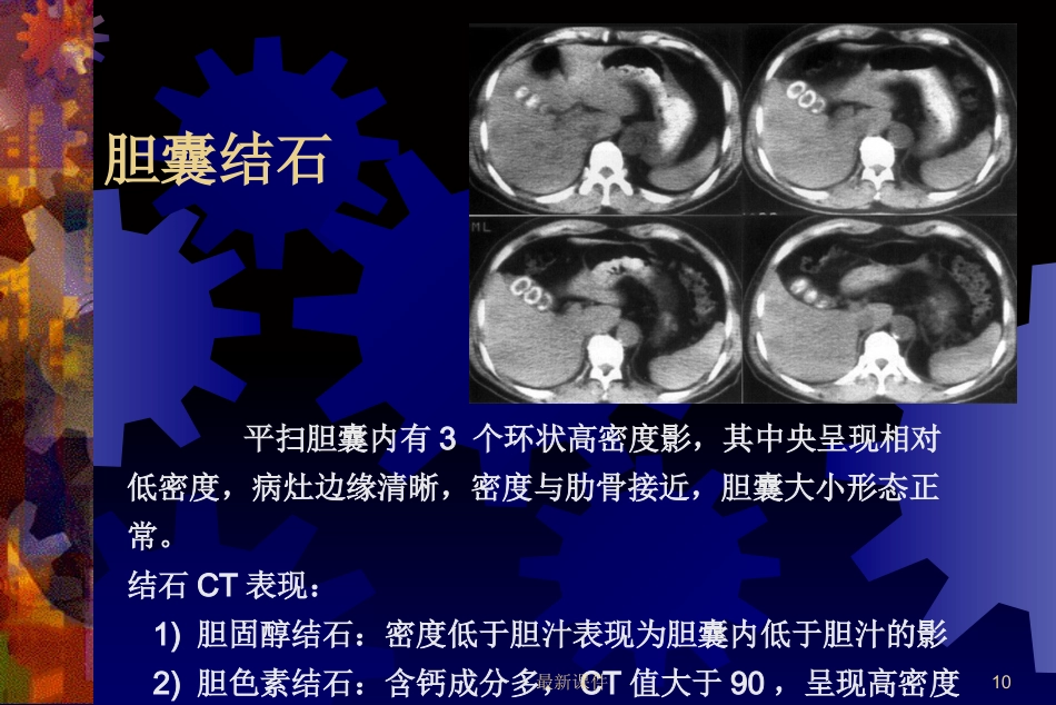 胆石症的中西医诊治最新_第10页