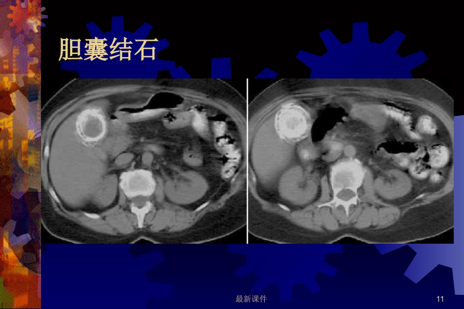 胆石症的中西医诊治最新_第11页