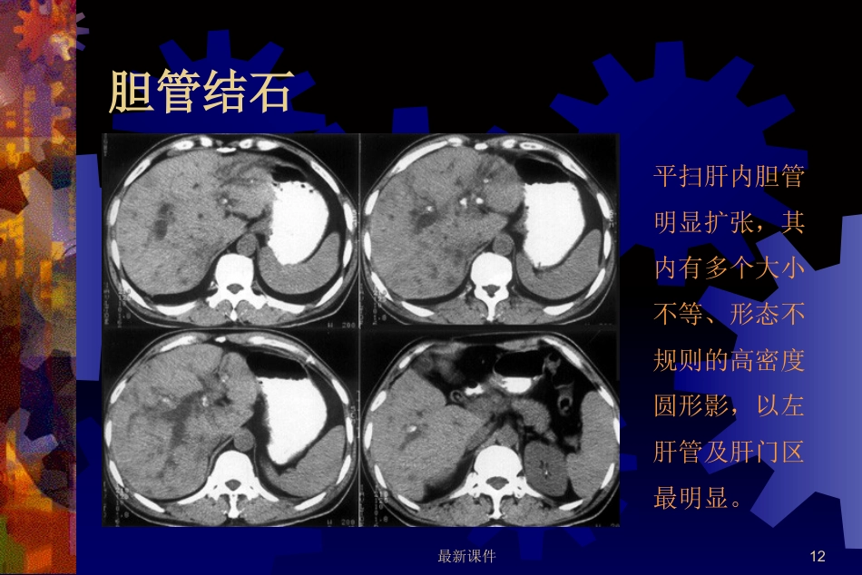 胆石症的中西医诊治最新_第12页