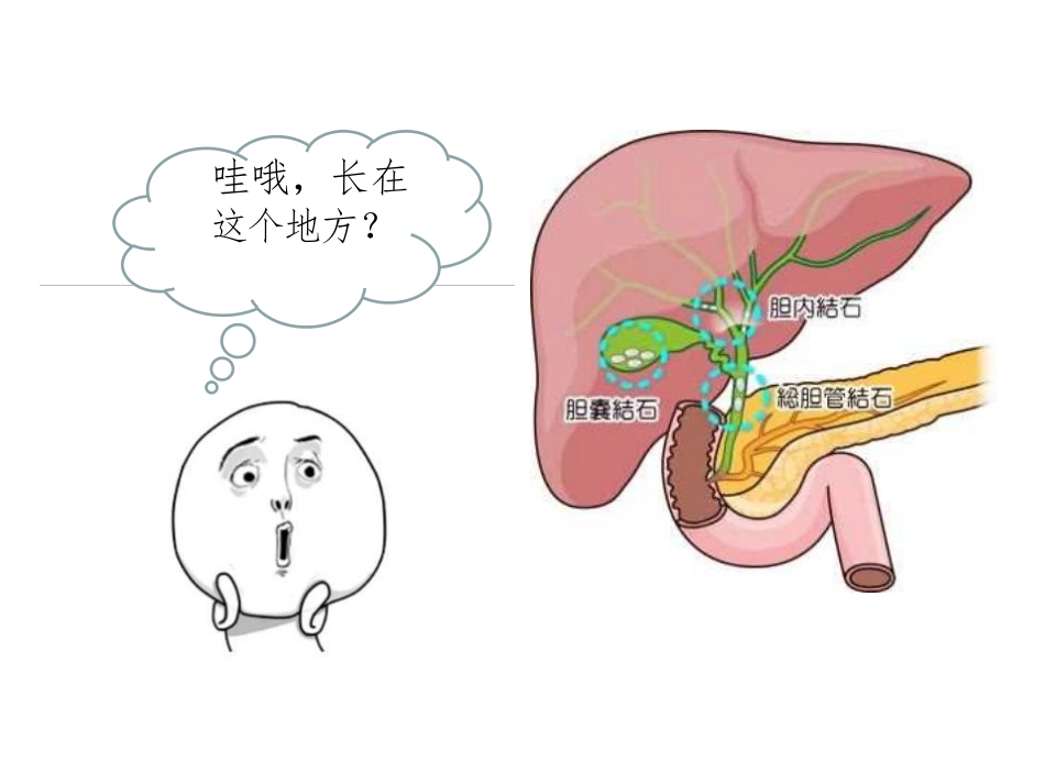 胆囊结石科普PPT幻灯片课件_第3页