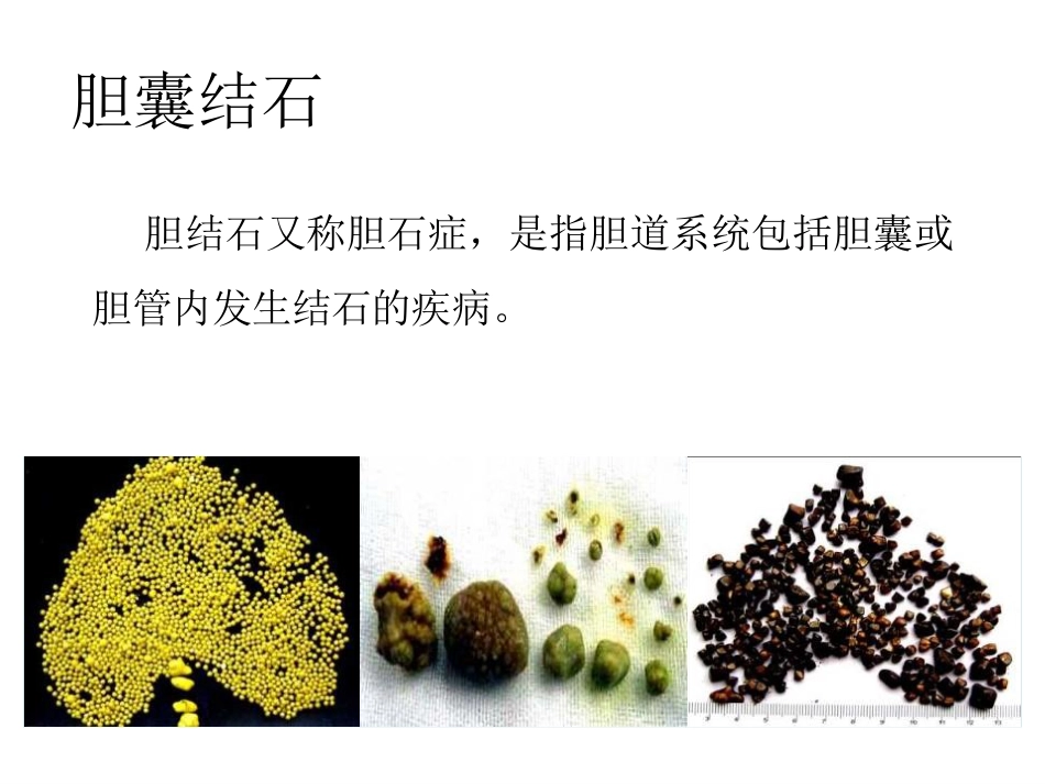 胆囊结石科普PPT幻灯片课件_第4页