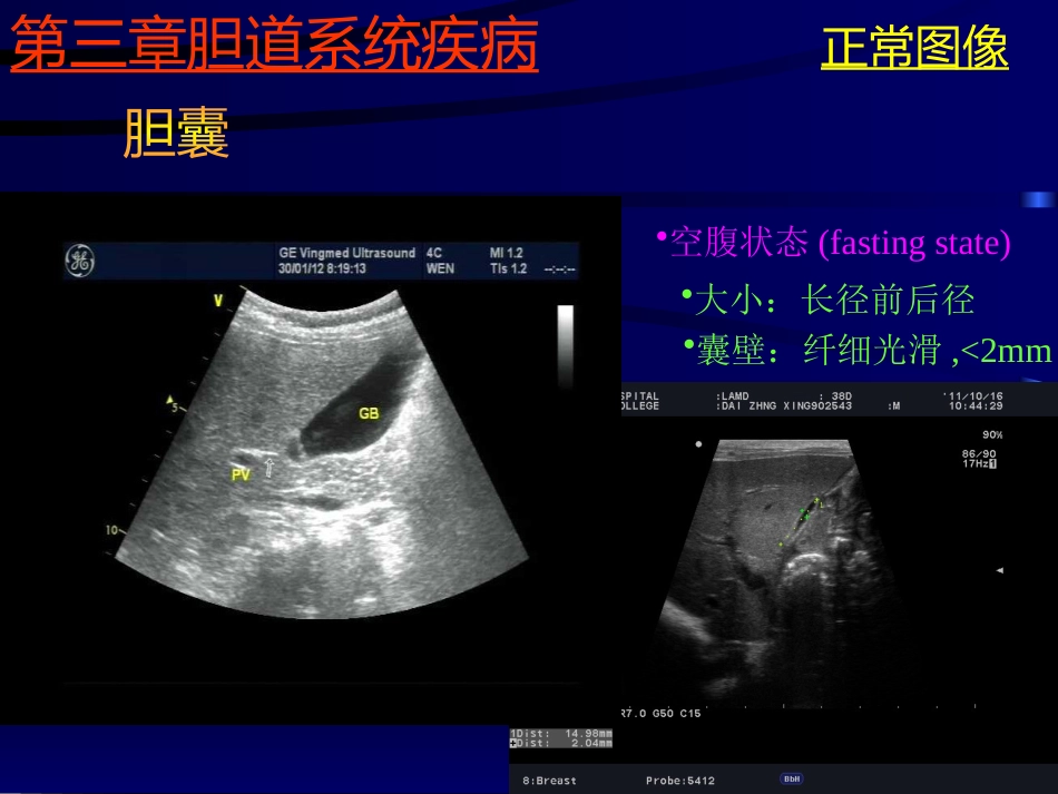 胆系疾病超声诊断(GY)_第10页