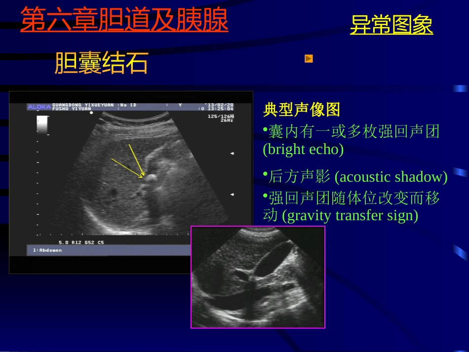 胆系疾病超声诊断(GY)_第11页