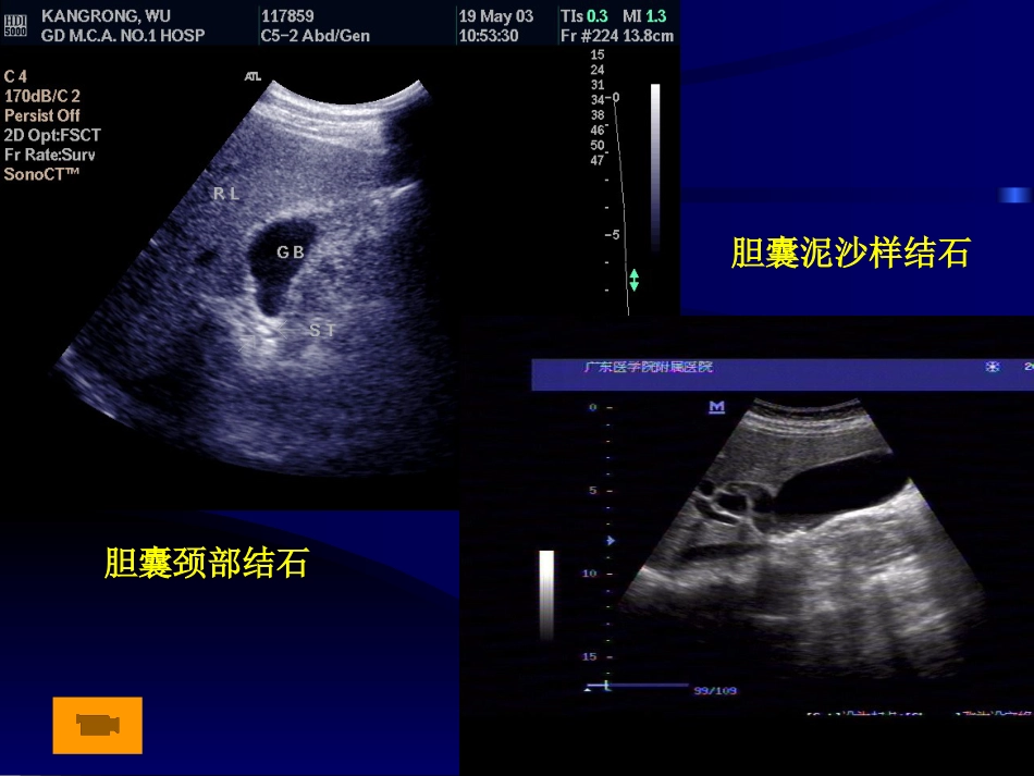 胆系疾病超声诊断(GY)_第14页