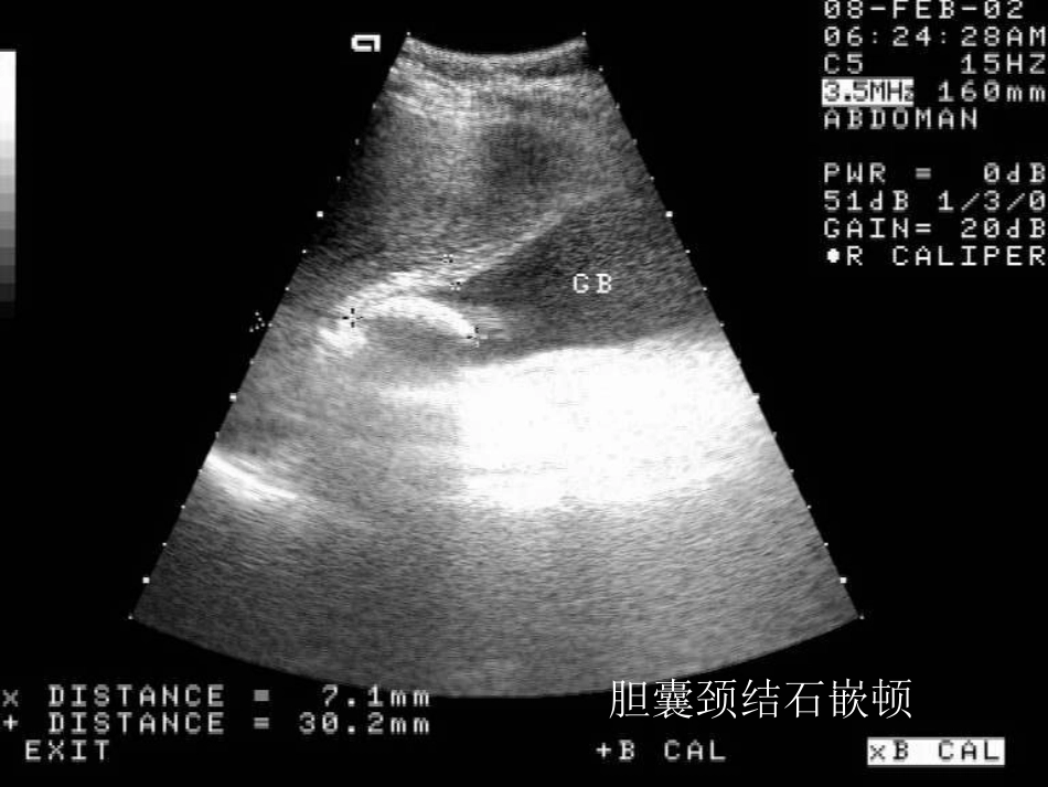 胆系疾病超声诊断(GY)_第15页