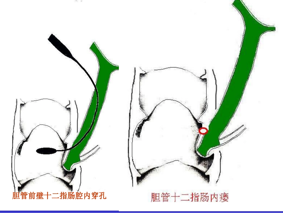 胆胰十二指肠汇合部穿孔的处理_第5页