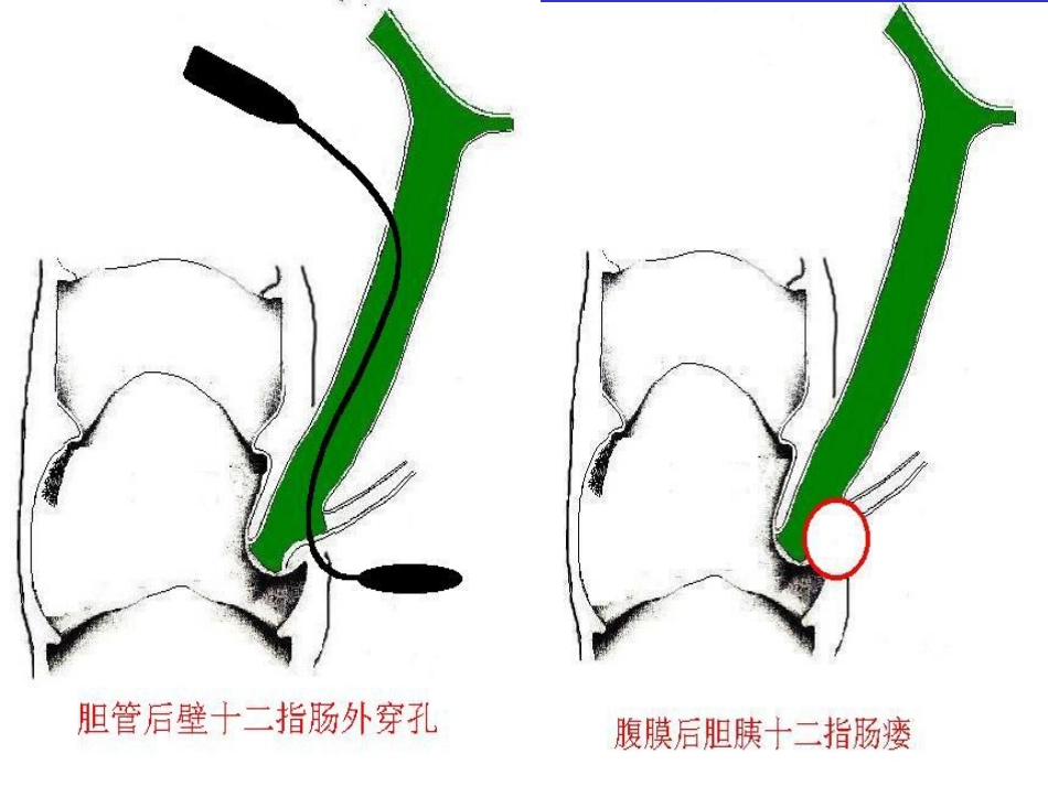 胆胰十二指肠汇合部穿孔的处理_第6页