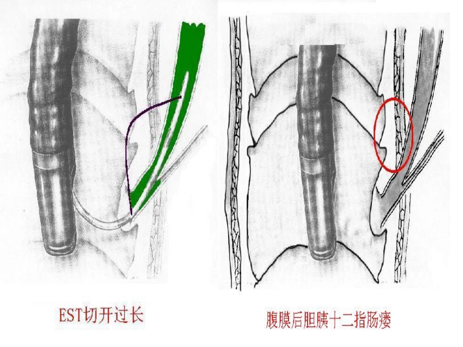 胆胰十二指肠汇合部穿孔的处理_第7页