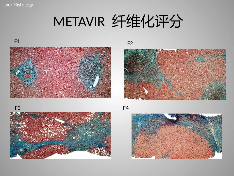 FibroScan在慢性肝病评估中的临床价值_第6页