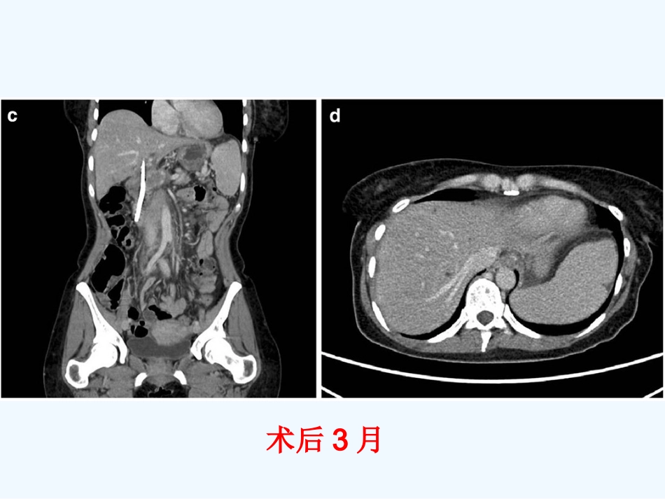 恶性胆道梗阻的射频消融治疗_第15页