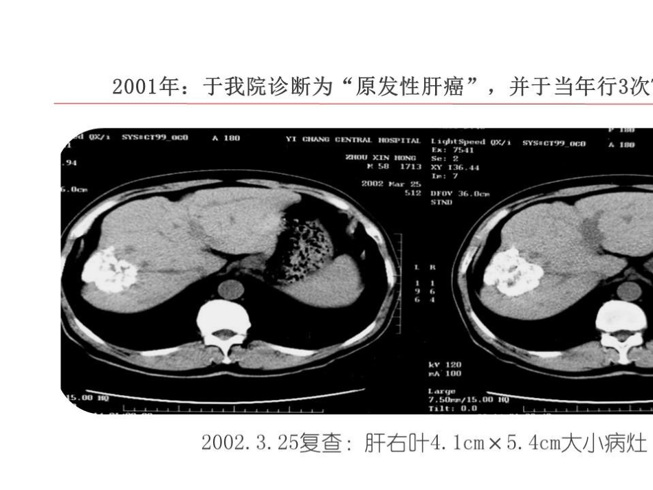 TlPS治疗肝癌合并门脉高压症的应用_第12页