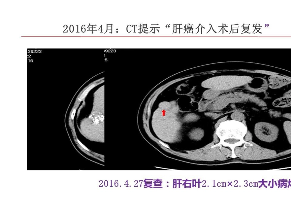 TlPS治疗肝癌合并门脉高压症的应用_第14页