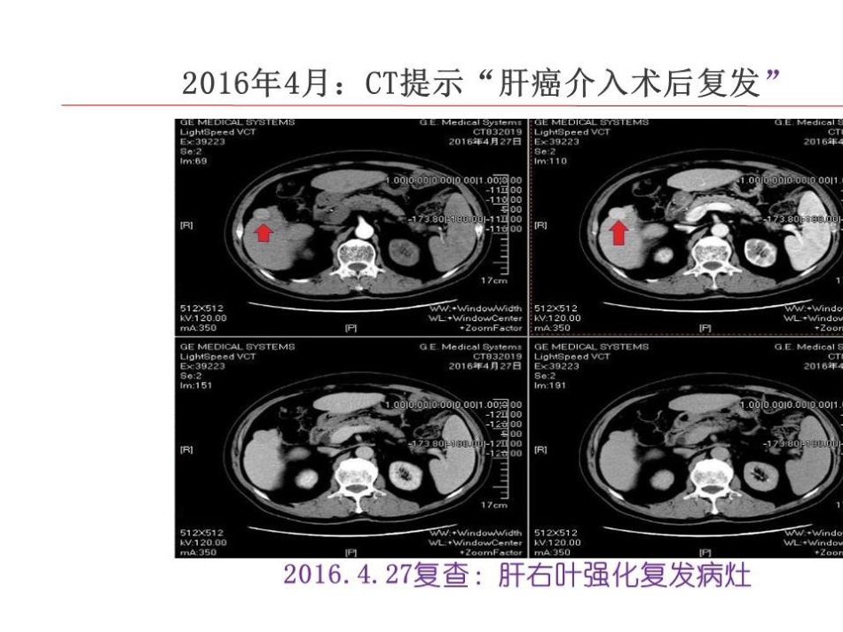 TlPS治疗肝癌合并门脉高压症的应用_第15页
