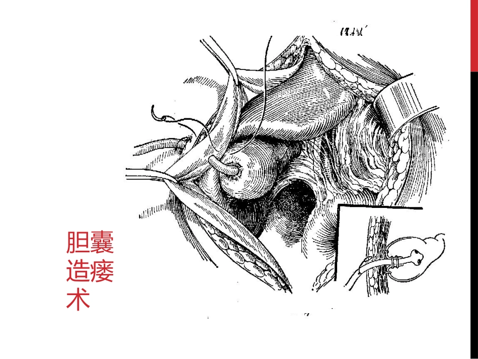 胆囊结石胆囊炎_第14页