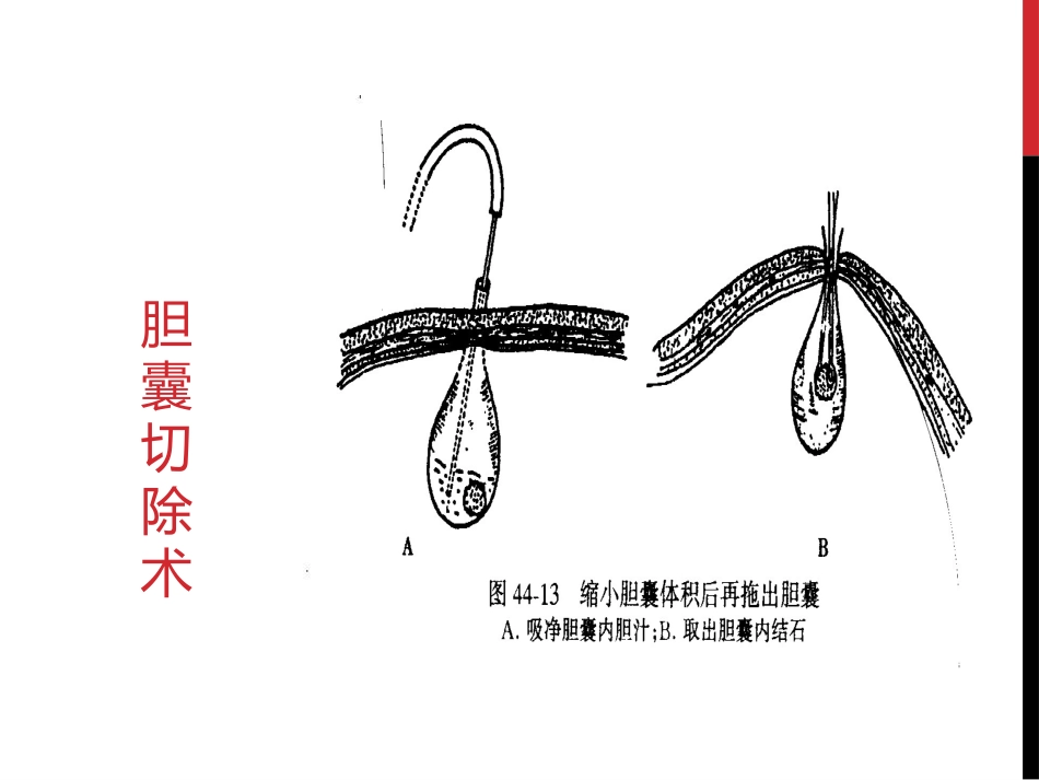 胆囊结石胆囊炎_第15页