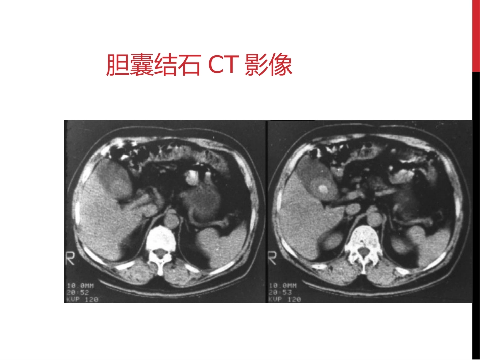 胆囊结石胆囊炎_第6页