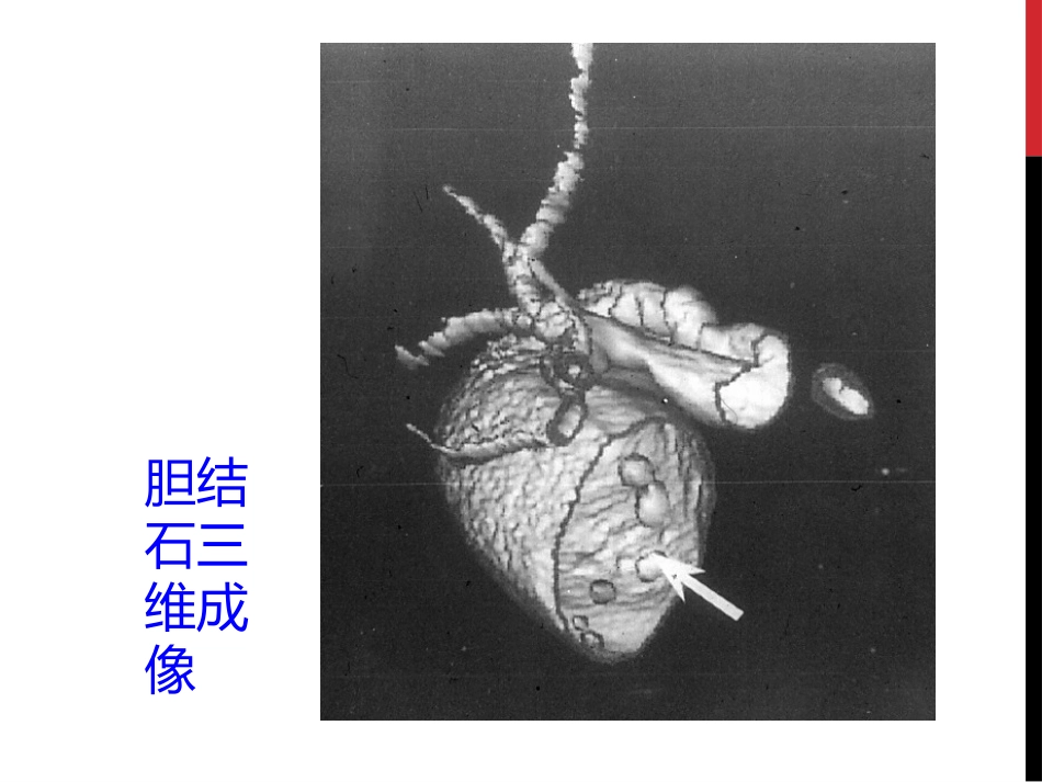 胆囊结石胆囊炎_第7页