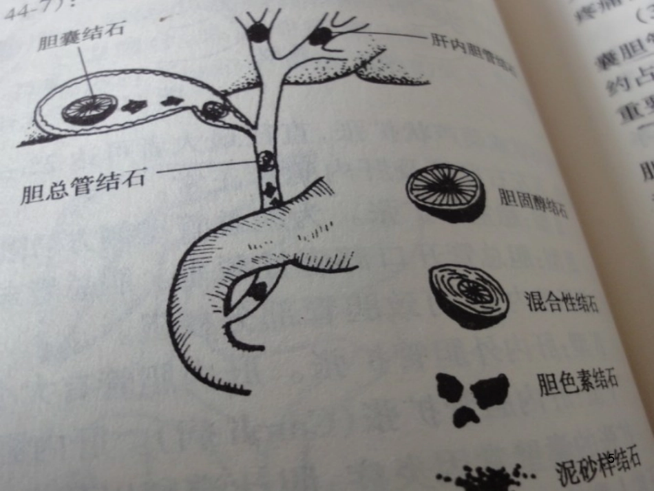 胆石病的诊断与治_第5页
