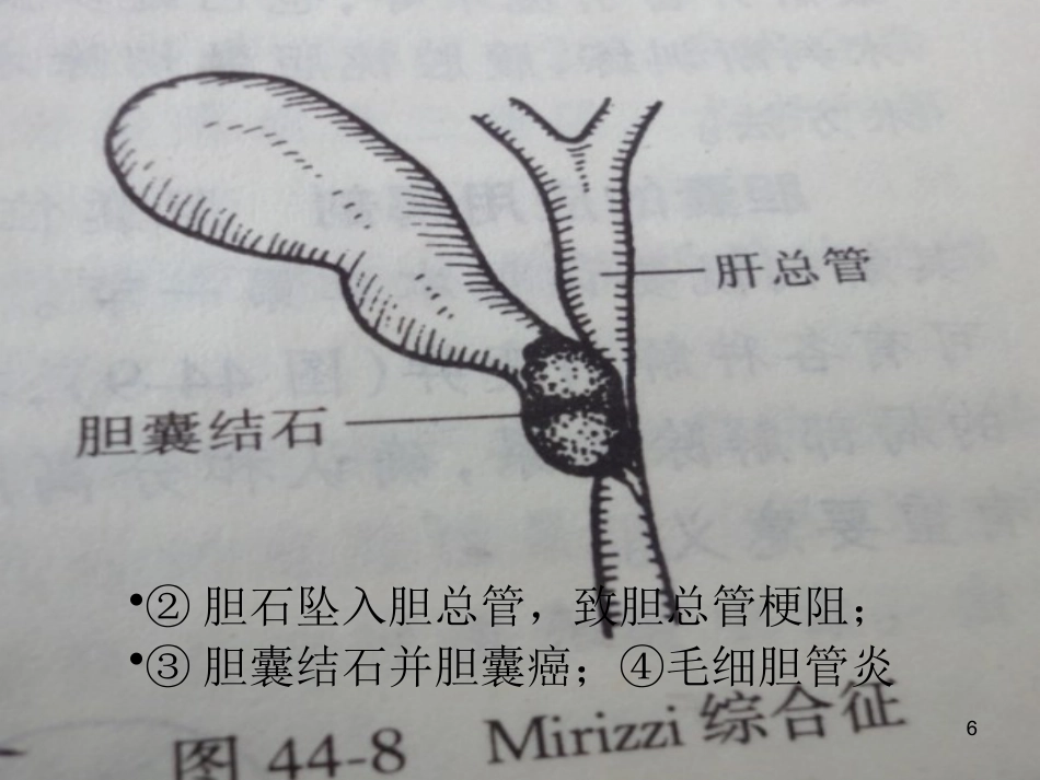 胆石病的诊断与治_第6页