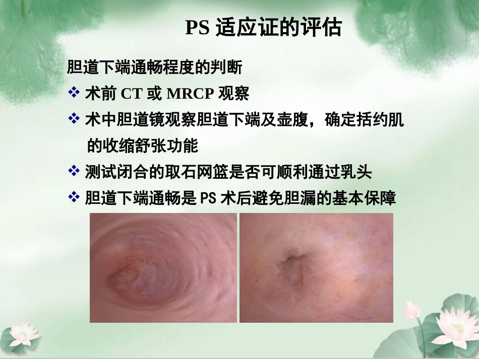 胆囊结石并发肝外胆管结石微创治疗规范解读成都_第15页