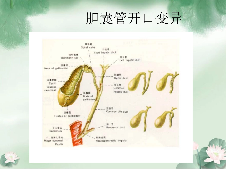 胆囊结石伴胆囊炎Ppt_第3页