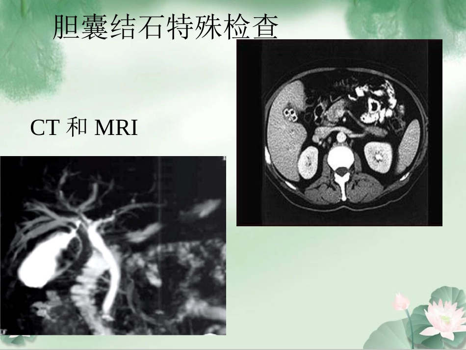 胆囊结石伴胆囊炎Ppt_第8页