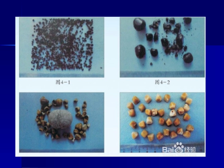 胆囊、胰腺常见疾病_第13页