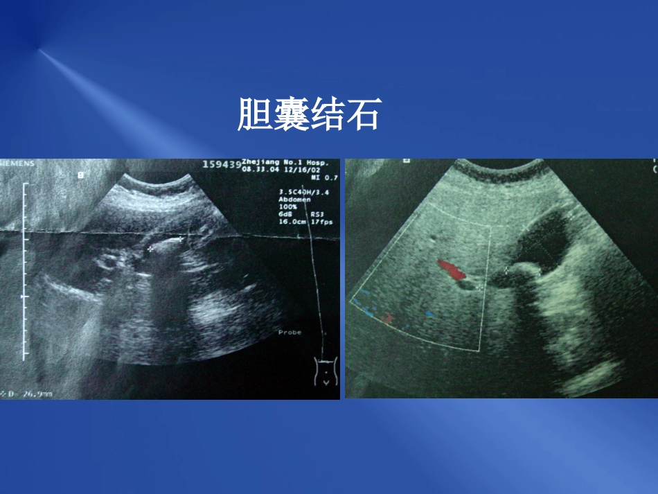 胆道疾病_第10页