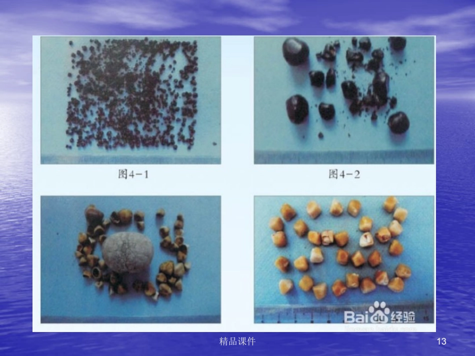 胆囊胰腺常见疾病医学PPT_第13页