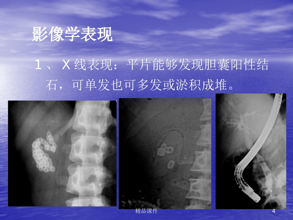 胆囊胰腺常见疾病医学PPT_第4页