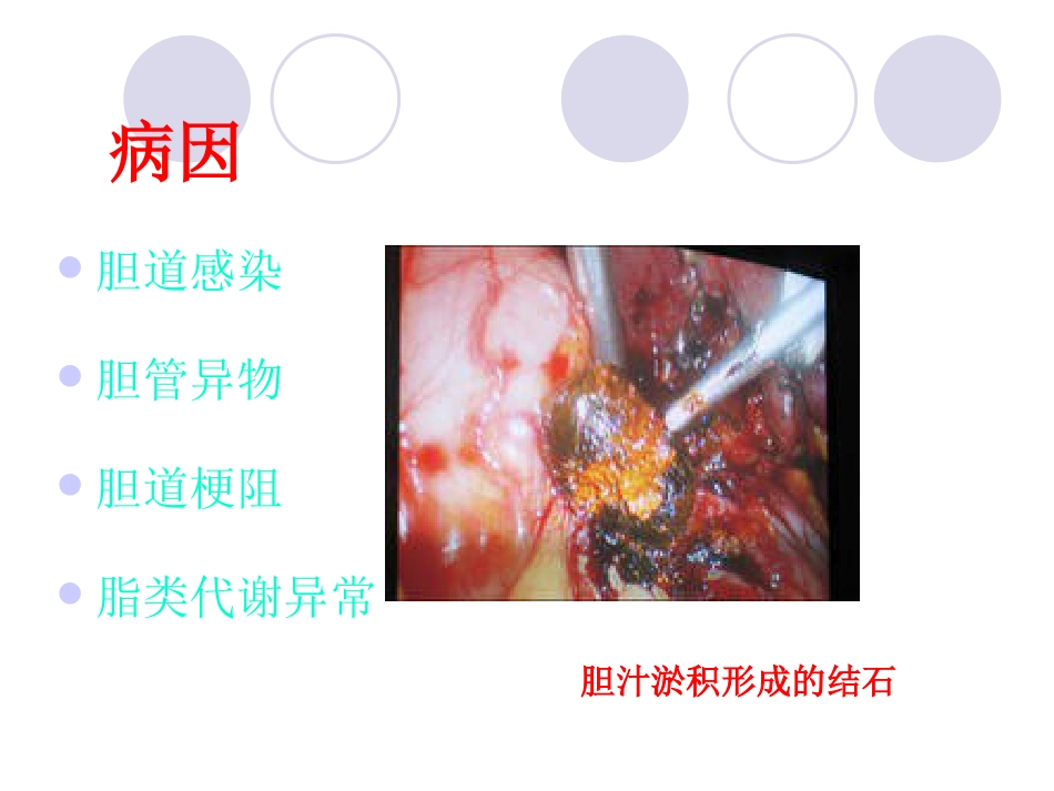 胆管结石_第5页