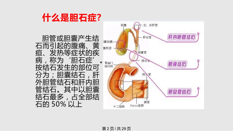胆囊结石的治疗_第2页