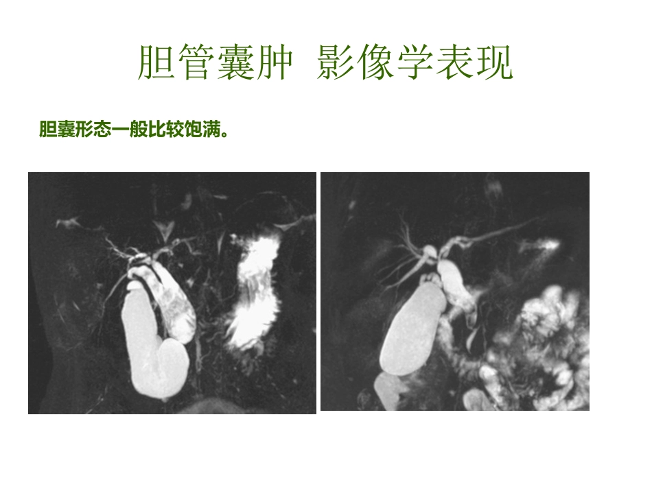 胆管囊肿_第13页
