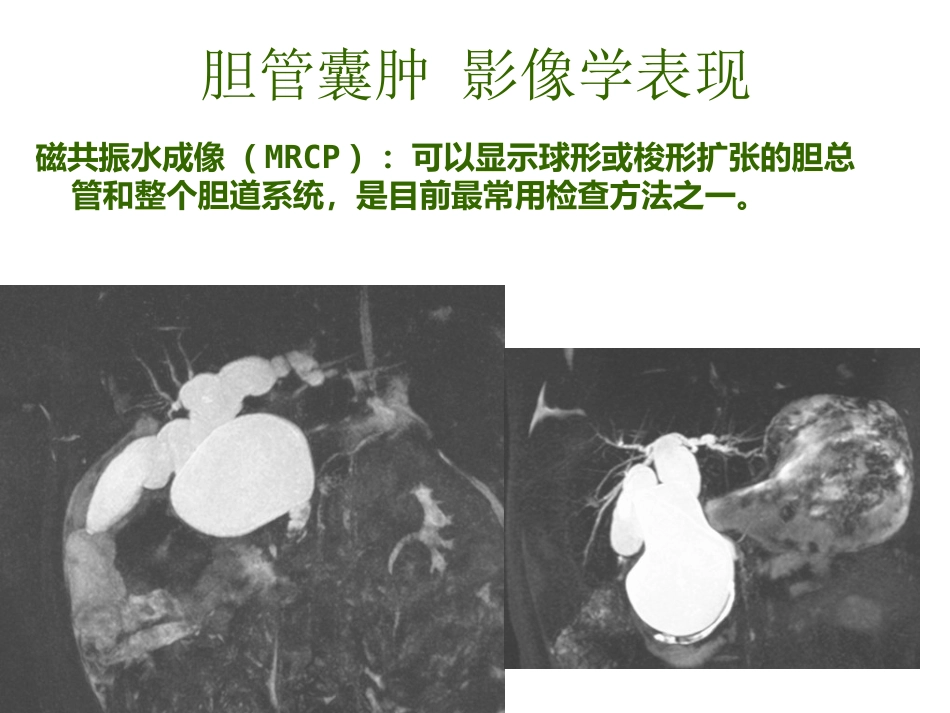 胆管囊肿_第14页