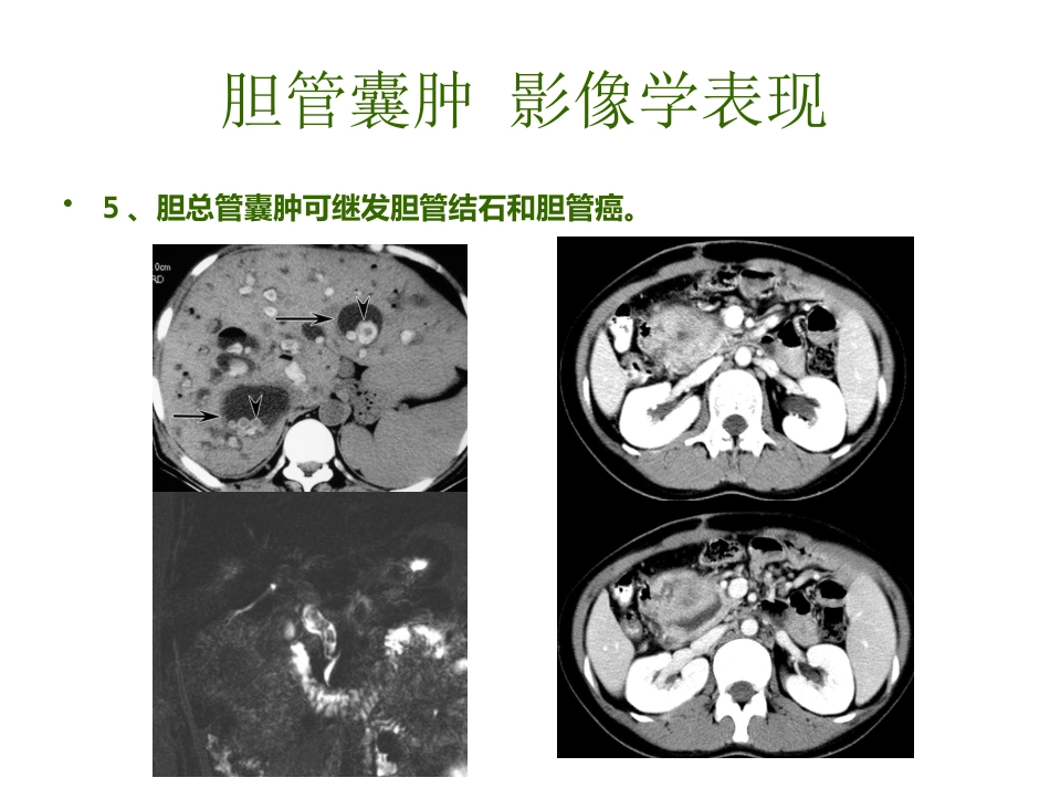 胆管囊肿_第15页