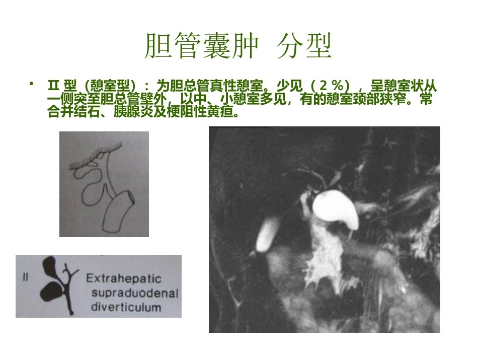 胆管囊肿_第5页