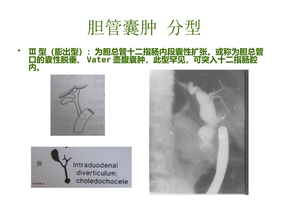 胆管囊肿_第6页
