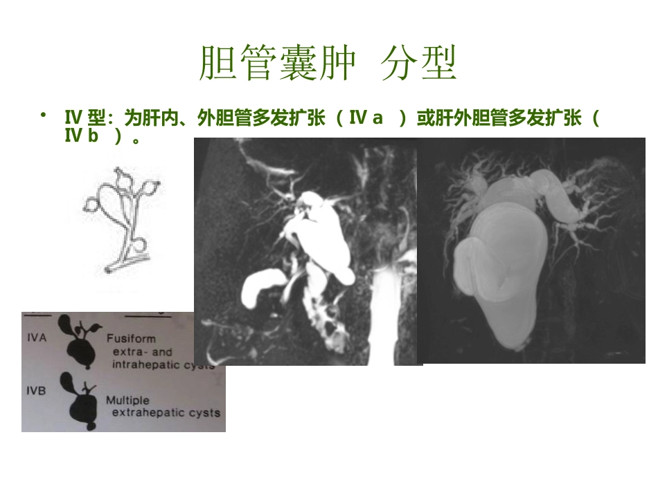 胆管囊肿_第7页