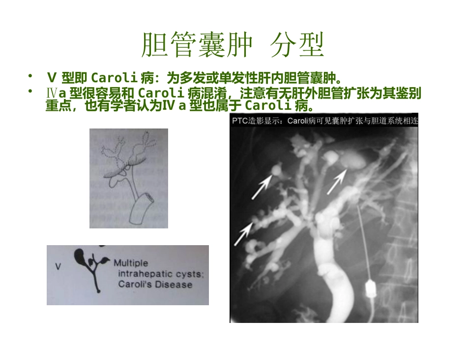 胆管囊肿_第8页