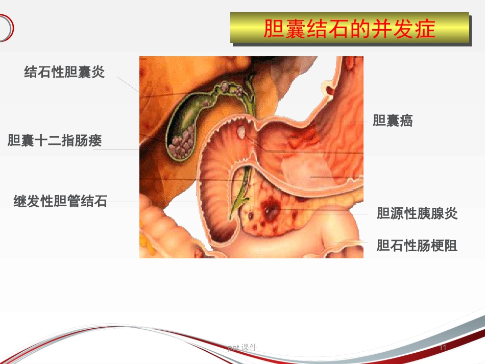 胆囊结石 ppt课件_第11页
